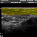 강병준 | 등 허리 옆구리 지방종 수술 실제 수술 후기