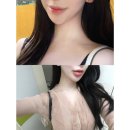 광대 | 강남 윤곽주사 전문 피부과 페이스하프컷 광대 이중턱 후기