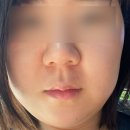 얼굴붓기빼는법에 미친 여자가 추천하는 브로멜라인 고함량 붓기 영양제
