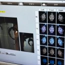 청담피부과 BBL레이저 후기,LDM 물방울초음파 재생관리까지 받은 일주일 효과