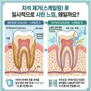 [남천역치과]스케일링 하면 치아가 깎이고 벌어지나요?