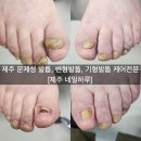 문제성 손발톱 전문관리 케어톱톱