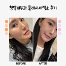 피부관리 | 청담피부과 플래시세렉소 피부관리 일주일 후기!