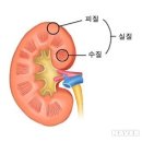 신장암(renal cell carcinoma) 이미지