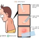 당뇨 합병증으로 발생하는 피부질환 이미지