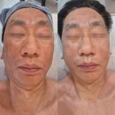 아이미 | 사각턱 콤플렉스 벗어난 대학생의 파주 페이스핏톡스 아이미뷰티끄 후기