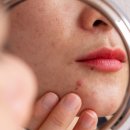 리부트짐(Reboot gym) | 피부과도 해결 못한 여드름 피부, 단 5주만에 깨끗해진 후기