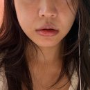 입술필러 녹인 후기 (필러 결절, 부작용, 디자인) 미묘한차이