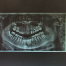 두루미약국 | 매복사랑니 뽑은 후기 | 신도림 연세사랑니치과의원