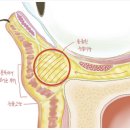 눈밑지방재배치잘하는곳, 후기? 믿지 마세요 - 의사 작성