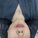 엄마의집 효도급식소 | 압구정피부과에서 효도선물로 엄마 모시고 세르프 리프팅 300샷 받고 온 일주일 후기