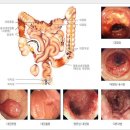 대장암 말기 살기위해 자연속으로 이미지