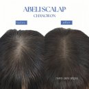 Abeli(아벨리) | 창원탈모성지 즉시 해결과 풍성함까지