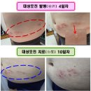 대상포진증상 초기 신경통 치료 후기 바늘로찌르는통증 평택 365소사벌종합의원 예방접종!