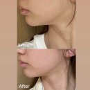 청담화장품 - 창원시 마산회원구 양덕북4길 67 | 청담 피부과 리타늄 솔직후기 리투오 티타늄 리프팅 통증 다운타임 부작용