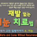 재발 없는 티눈의 치료 방법과 원인 이미지