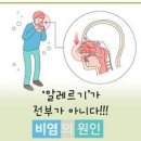 비염에 좋은음식 비염 원인 증상 치료 비염 종류 이미지