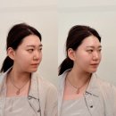 제이인셀덤 | 대구 리프팅관리 추천｜ 속전속결! 30분 리프팅, 제이라인코리아 에어젯 솔직후기
