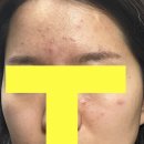 예안치과의원 | 모낭염과의 싸움