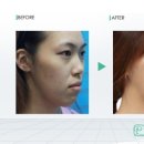 사각턱+광대를 동시에~ 베이비 페이스 성형!