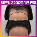 [30대 여자 넓은 M자 헤어라인 머리심기] 비절개 히든컷 모발이식 3200모 1년 후기 (모엠의원/헤어라인/전지훈원장) 이미지