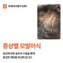 대구 모발이식 센터 증상에 따른 처치 솔루션