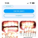 임플라인치과의원의정부점 | 치아노트로 치아관리 : 강남 임플라인 치과 치아미백 스케일링 후기