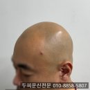 익산병원 | 익산두피탈모병원 가격·비용·효과 후기, 솔직하게 말씀드립니다