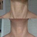 청담동 목주름 필러 내돈내산 재방문 후기