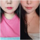 디아큐에어 | 김해피부과 내돈내산 윤곽주사 보톡스 아큐주사 솔직후기