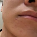 용인 피부과 메이퓨어의원 수지점, 카프리레이저 여드름 원인 치료 6회차 후기
