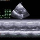 hypertrophic cardiomyopathy (HCMP) 이미지