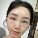 송도로이약국 | 내시경이마거상 리얼후기 (1-3일차)