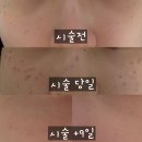 루비PC | 루비레이저 후기] 서면 루비레이저 피부과 추천, 주근깨 루비레이저 딱지 경과 후기, 루비레이저 경과...