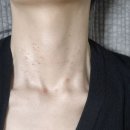 1주전 점빼고 쥐젖 관리요(사진징그러움주의) 이미지
