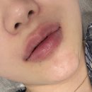 통통스 | 수원 인계동 입술필러 후기 내돈내산으로 만족도 최상..