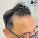 지스칼프