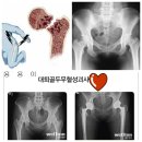 인공관절치환술=＞고관절 이미지