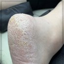 레푸스대전둔산점&더예쁜손발톱 | 전문적인 발각질 관리로 새로워진 내 발, 대전 내성발톱 레푸스대전둔산점&더예쁜손발톱