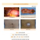 급만성담낭염수술후기. 강 검진 시 기존 용종의 크기가 2.3cm 이상 커져 있다고 확인되어 담낭관련 전문의 김정윤 원장님... 이미지