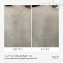 더모어 | 부산 서면 등드름 관리 팔모공각화증 제대로 잘해주는곳 더모어뷰티 후기