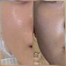 루희에스테틱 | 수원 화서동 피부관리 : 알찬 엑스터레이저 효과본 루희에스테틱