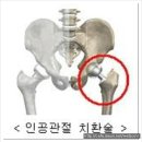 고관절 인공관절 -고관절 인공관절 수술잘하는 곳:웰튼병원 이미지