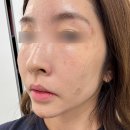 르아뷰티&솔에스테틱부산서면점 | 부산 서면 점제거 내돈내산 솔직 후기, 눈썹 밑 피지증식증도 같이 정리