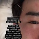 안면가스 이미지