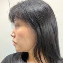 닥터남아름다운의원 | 신사 올타이트리프팅 하프해진 이중턱 피부클리닉의원 전후 후기 (통증X, 가격, 다운타임X)