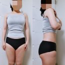 글로벌365mc병원 | 구월동복부지방흡입 효과와 후기 알아보기