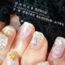 강자안손톱 이미지