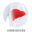 간이 굳어지는 간경변증 간경화증의 원인 증상 및 치료 위한 환자 생활수칙 이미지