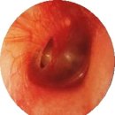 전정신경염 (Vestibular neuronitis)ㅡ외상에 의한 고막 천공 이미지